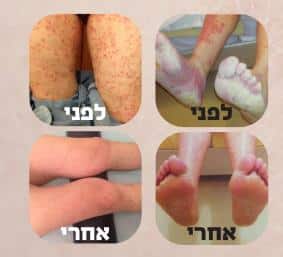 טיפול בפסוריאזיס - תמונות לפני ואחרי הטיפול | מרפאת צוף צמחים טיפול בפסוריאזיס - תמונות לפני ואחרי הטיפול | מרפאת צוף צמחים